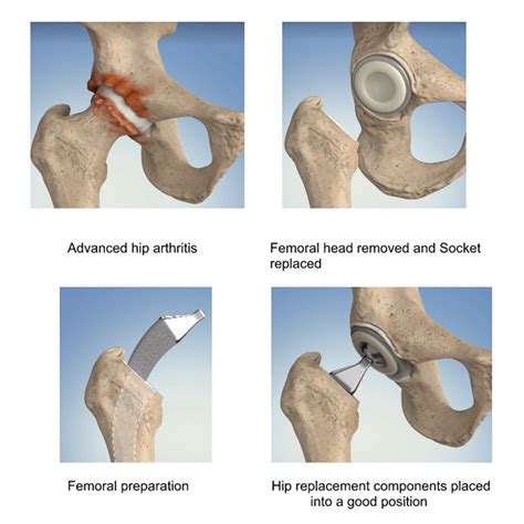 hip replacement greenwich|Total Hip Replacement .